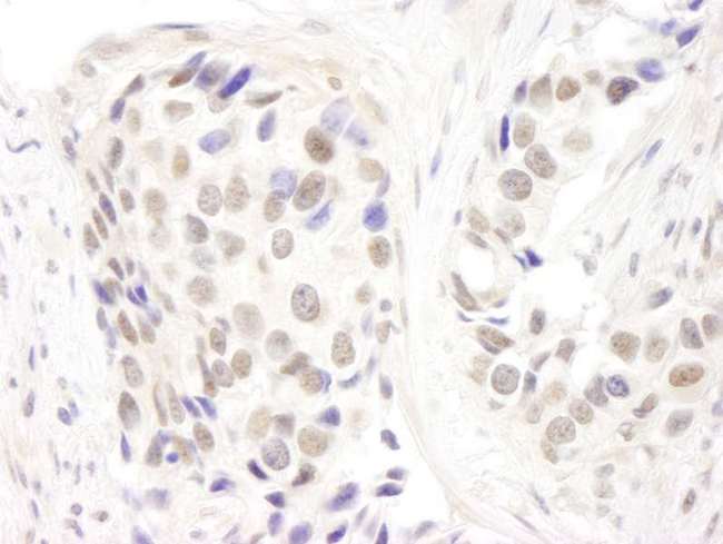 GATAD2A Antibody - Detection of Human p66alpha by Immunohistochemistry. Sample: FFPE section of human breast carcinoma. Antibody: Affinity purified rabbit anti-p66alpha used at a dilution of 1:250.