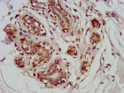 GATAD2A Antibody - Immunohistochemistry image at a dilution of 1:800 and staining in paraffin-embedded human breast cancer performed on a Leica BondTM system. After dewaxing and hydration, antigen retrieval was mediated by high pressure in a citrate buffer (pH 6.0) . Section was blocked with 10% normal goat serum 30min at RT. Then primary antibody (1% BSA) was incubated at 4 °C overnight. The primary is detected by a biotinylated secondary antibody and visualized using an HRP conjugated SP system.