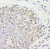 GATAD2B Antibody - Detection of Human p66beta/GATAD2B by Immunohistochemistry. Sample: FFPE section of human small cell lung cancer. Antibody: Affinity purified rabbit anti-p66beta/GATAD2B used at a dilution of 1:250.
