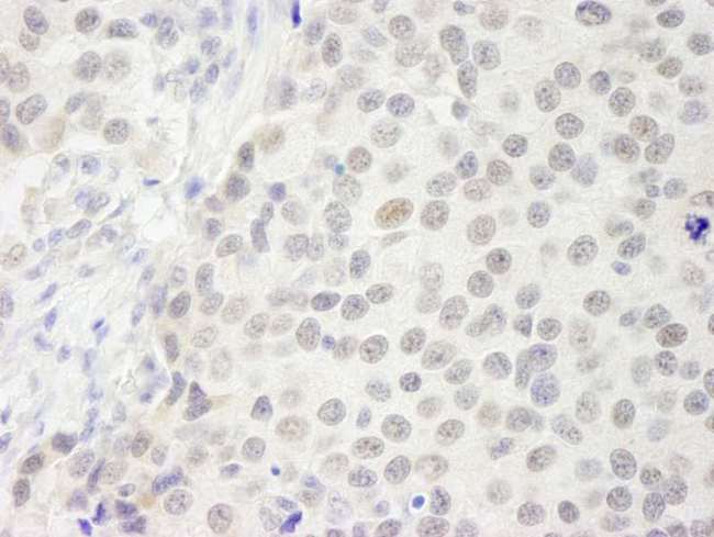 GATAD2B Antibody - Detection of Human p66beta/GATAD2B by Immunohistochemistry. Sample: FFPE section of human breast carcinoma. Antibody: Affinity purified rabbit anti-p66beta/GATAD2B used at a dilution of 1:250.