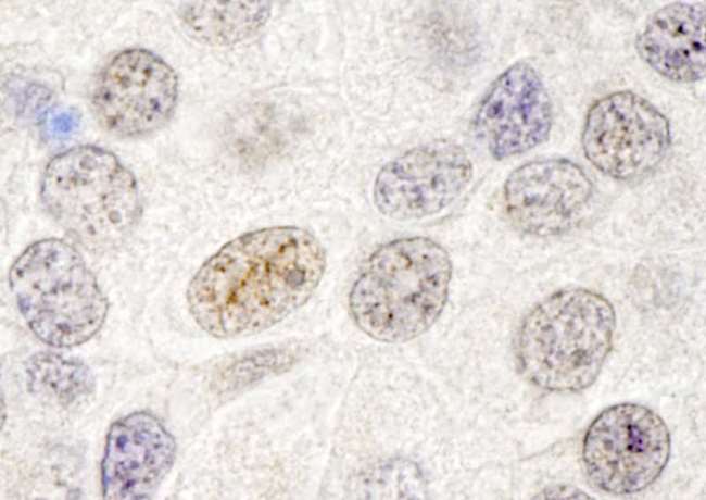GATAD2B Antibody - Detection of Human p66beta/GATAD2B by Immunohistochemistry. Sample: FFPE section of human breast carcinoma. Antibody: Affinity purified rabbit anti-p66beta/GATAD2B used at a dilution of 1:250.