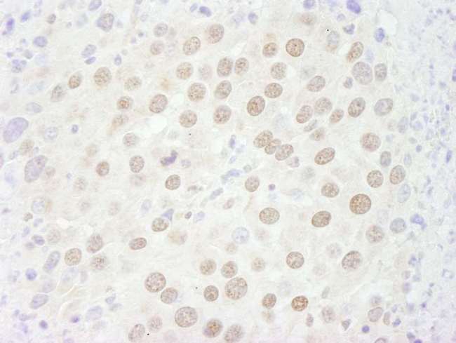 GATAD2B Antibody - Detection of Mouse p66beta/GATAD2B by Immunohistochemistry. Sample: FFPE section of mouse renal cell carcinoma. Antibody: Affinity purified rabbit anti-p66beta/GATAD2B used at a dilution of 1:250.