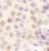 GATAD2B Antibody - Detection of Human p66beta/GATAD2B by Immunohistochemistry. Sample: FFPE section of human breast carcinoma. Antibody: Affinity purified rabbit anti-p66beta/GATAD2B used at a dilution of 1:200 (1 ug/ml). Detection: DAB.
