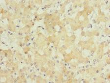 GATC Antibody - Immunohistochemistry of paraffin-embedded human liver cancer at dilution 1:100