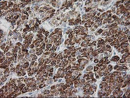 GATM / AGAT Antibody - IHC of paraffin-embedded Carcinoma of Human liver tissue using anti-GATM mouse monoclonal antibody, at a dilution of 1:150.