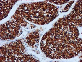 GATM / AGAT Antibody - IHC of paraffin-embedded Carcinoma of Human liver tissue using anti-GATM mouse monoclonal antibody. (Heat-induced epitope retrieval by 10mM citric buffer, pH6.0, 100C for 10min).
