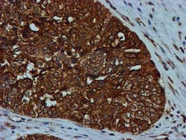 GATM / AGAT Antibody - IHC of paraffin-embedded Adenocarcinoma of Human ovary tissue using anti-GATM mouse monoclonal antibody. (Heat-induced epitope retrieval by 10mM citric buffer, pH6.0, 100C for 10min).