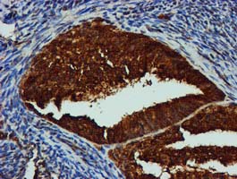 GATM / AGAT Antibody - IHC of paraffin-embedded Adenocarcinoma of Human endometrium tissue using anti-GATM mouse monoclonal antibody. (Heat-induced epitope retrieval by 10mM citric buffer, pH6.0, 100C for 10min).