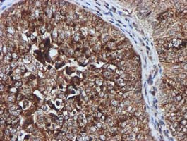 GATM / AGAT Antibody - IHC of paraffin-embedded Carcinoma of Human bladder tissue using anti-GATM mouse monoclonal antibody. (Heat-induced epitope retrieval by 10mM citric buffer, pH6.0, 100C for 10min).