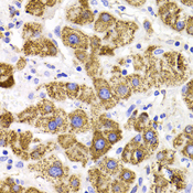 GATM / AGAT Antibody - Immunohistochemistry of paraffin-embedded liver cancer tissue.