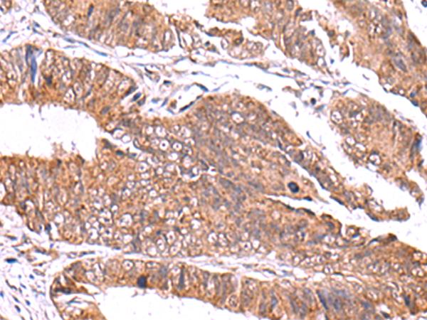 GATM / AGAT Antibody - Immunohistochemistry of paraffin-embedded Human colorectal cancer tissue  using GATM Polyclonal Antibody at dilution of 1:70(×200)