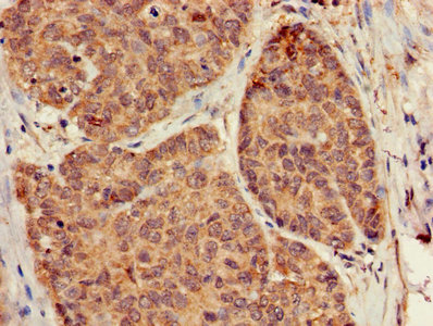 GB5 / GNB5 Antibody - Immunohistochemistry of paraffin-embedded human ovarian cancer using GNB5 Antibody at dilution of 1:100