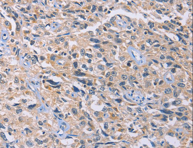 GB5 / GNB5 Antibody - Immunohistochemistry of paraffin-embedded Human esophagus cancer using GNB5 Polyclonal Antibody at dilution of 1:20.