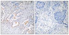 GB5 / GNB5 Antibody - Peptide - + Immunohistochemistry analysis of paraffin-embedded human lung carcinoma tissue using GNB5 antibody.