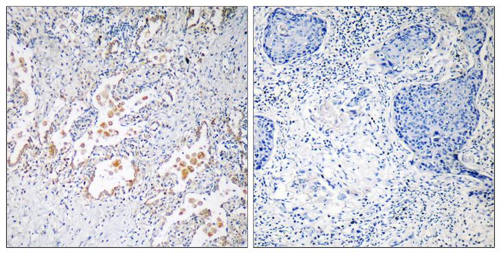 GB5 / GNB5 Antibody - Peptide - + Immunohistochemistry analysis of paraffin-embedded human lung carcinoma tissue using GNB5 antibody.