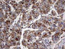 GBA / Glucosidase Beta Acid Antibody - IHC of paraffin-embedded Carcinoma of Human liver tissue using anti-GBA mouse monoclonal antibody. (Heat-induced epitope retrieval by 10mM citric buffer, pH6.0, 120°C for 3min).