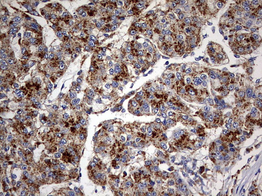 GBA / Glucosidase Beta Acid Antibody - IHC of paraffin-embedded Carcinoma of Human liver tissue using anti-GBA mouse monoclonal antibody. (Heat-induced epitope retrieval by 10mM citric buffer, pH6.0, 120°C for 3min).