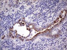 GBA / Glucosidase Beta Acid Antibody - IHC of paraffin-embedded Carcinoma of Human lung tissue using anti-GBA mouse monoclonal antibody. (Heat-induced epitope retrieval by 1 mM EDTA in 10mM Tris, pH8.5, 120°C for 3min).