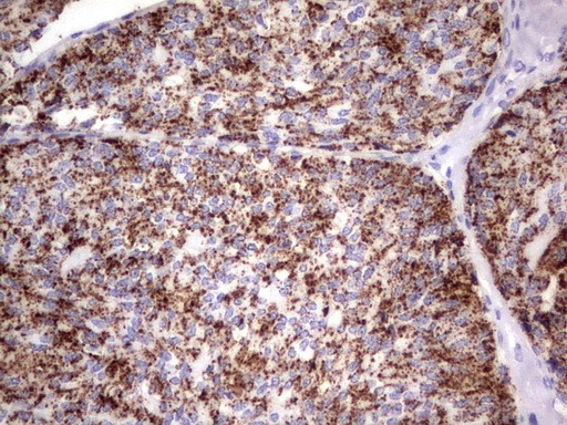 GBA / Glucosidase Beta Acid Antibody - IHC of paraffin-embedded Human thyroid tissue using anti-GBA mouse monoclonal antibody. (Heat-induced epitope retrieval by 1 mM EDTA in 10mM Tris, pH8.5, 120°C for 3min).