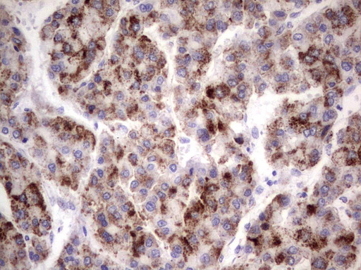 GBA / Glucosidase Beta Acid Antibody - IHC of paraffin-embedded Carcinoma of Human prostate tissue using anti-GBA mouse monoclonal antibody. (Heat-induced epitope retrieval by 1 mM EDTA in 10mM Tris, pH8.5, 120°C for 3min).