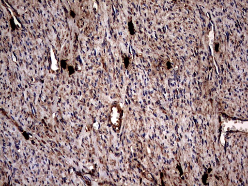 GBA / Glucosidase Beta Acid Antibody - IHC of paraffin-embedded Adenocarcinoma of Human endometrium tissue using anti-GBA mouse monoclonal antibody. (Heat-induced epitope retrieval by 1 mM EDTA in 10mM Tris, pH8.5, 120°C for 3min).