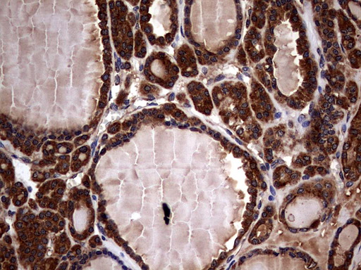 GBA / Glucosidase Beta Acid Antibody - IHC of paraffin-embedded Carcinoma of Human thyroid tissue using anti-GBA mouse monoclonal antibody. (Heat-induced epitope retrieval by 1 mM EDTA in 10mM Tris, pH8.5, 120°C for 3min).