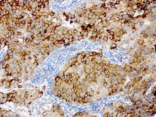GBA / Glucosidase Beta Acid Antibody - Immunohistochemical staining of paraffin-embedded human melanoma using anti- GBA clone UMAB171 mouse monoclonal antibody at 1:200 dilution of 1.0 mg/mL using Polink2 Broad HRP DAB for detection.requires HIER with with Accel 3in1 EDTA solution ph8.7 at 110C for 3 min using pressure chamber/cooker. The tumor cells shows strong membraneous and cytoplasmic staining.