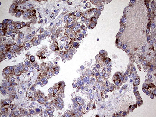 GBA / Glucosidase Beta Acid Antibody - Immunohistochemical staining of paraffin-embedded Adenocarcinoma of Human ovary tissue using anti-GBA mouse monoclonal antibody.  heat-induced epitope retrieval by 1 mM EDTA in 10mM Tris, pH8.0, 120C for 3min)