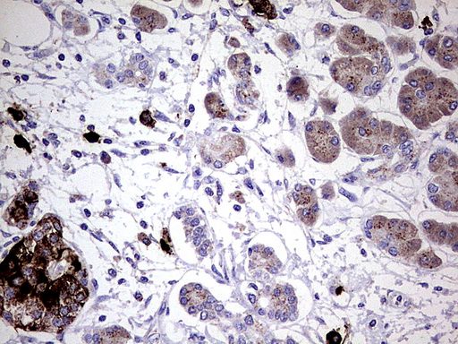 GBA / Glucosidase Beta Acid Antibody - Immunohistochemical staining of paraffin-embedded Carcinoma of Human pancreas tissue using anti-GBA mouse monoclonal antibody.  heat-induced epitope retrieval by 1 mM EDTA in 10mM Tris, pH8.0, 120C for 3min)