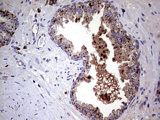 GBA / Glucosidase Beta Acid Antibody - Immunohistochemical staining of paraffin-embedded Carcinoma of Human prostate tissue using anti-GBA mouse monoclonal antibody.  heat-induced epitope retrieval by 1 mM EDTA in 10mM Tris, pH8.0, 120C for 3min)