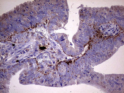 GBA / Glucosidase Beta Acid Antibody - Immunohistochemical staining of paraffin-embedded Adenocarcinoma of Human colon tissue using anti-GBA mouse monoclonal antibody.  heat-induced epitope retrieval by 1 mM EDTA in 10mM Tris, pH8.0, 120C for 3min)