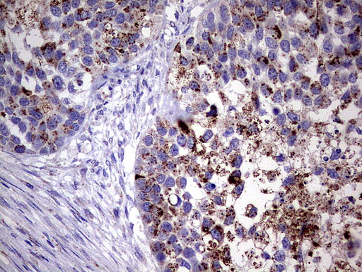 GBA / Glucosidase Beta Acid Antibody - Immunohistochemical staining of paraffin-embedded Carcinoma of Human kidney tissue using anti-GBA mouse monoclonal antibody.  heat-induced epitope retrieval by 1 mM EDTA in 10mM Tris, pH8.0, 120C for 3min)