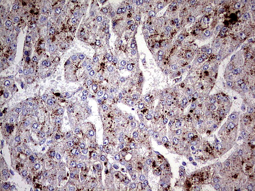 GBA / Glucosidase Beta Acid Antibody - Immunohistochemical staining of paraffin-embedded Carcinoma of Human liver tissue using anti-GBA mouse monoclonal antibody.  heat-induced epitope retrieval by 1 mM EDTA in 10mM Tris, pH8.0, 120C for 3min)