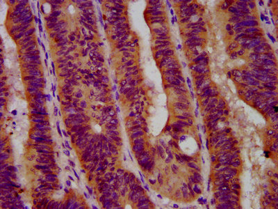 GBA / Glucosidase Beta Acid Antibody - Immunohistochemistry Dilution at 1:600 and staining in paraffin-embedded human colon cancer performed on a Leica BondTM system. After dewaxing and hydration, antigen retrieval was mediated by high pressure in a citrate buffer (pH 6.0). Section was blocked with 10% normal Goat serum 30min at RT. Then primary antibody (1% BSA) was incubated at 4°C overnight. The primary is detected by a biotinylated Secondary antibody and visualized using an HRP conjugated SP system.