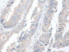 GBA2 Antibody - Immunohistochemistry of paraffin-embedded Human colorectal cancer tissue  using GBA2 Polyclonal Antibody at dilution of 1:55(×200)