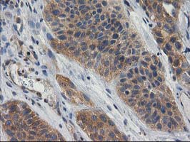 GBA3 / CBG Antibody - IHC of paraffin-embedded Carcinoma of Human bladder tissue using anti-GBA3 mouse monoclonal antibody.