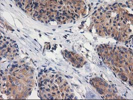 GBA3 / CBG Antibody - IHC of paraffin-embedded Adenocarcinoma of Human breast tissue using anti-GBA3 mouse monoclonal antibody.