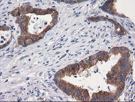 GBA3 / CBG Antibody - IHC of paraffin-embedded Adenocarcinoma of Human colon tissue using anti-GBA3 mouse monoclonal antibody.