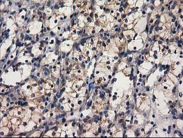 GBA3 / CBG Antibody - IHC of paraffin-embedded Carcinoma of Human kidney tissue using anti-GBA3 mouse monoclonal antibody.