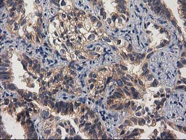 GBA3 / CBG Antibody - IHC of paraffin-embedded Carcinoma of Human lung tissue using anti-GBA3 mouse monoclonal antibody.