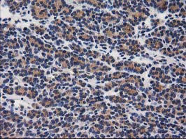 GBA3 / CBG Antibody - IHC of paraffin-embedded Carcinoma of Human thyroid tissue using anti-GBA3 mouse monoclonal antibody.
