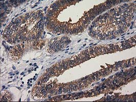 GBA3 / CBG Antibody - IHC of paraffin-embedded Adenocarcinoma of Human endometrium tissue using anti-GBA3 mouse monoclonal antibody.