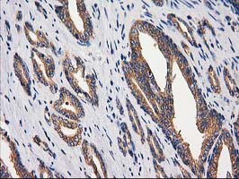 GBA3 / CBG Antibody - IHC of paraffin-embedded Carcinoma of Human prostate tissue using anti-GBA3 mouse monoclonal antibody.