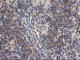 GBA3 / CBG Antibody - IHC of paraffin-embedded Human lymphoma tissue using anti-GBA3 mouse monoclonal antibody.