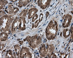 GBE1 Antibody - IHC of paraffin-embedded Carcinoma of prostate tissue using anti-GBE1 mouse monoclonal antibody. (Dilution 1:50).
