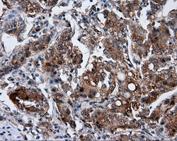 GBE1 Antibody - IHC of paraffin-embedded Carcinoma of liver tissue using anti-GBE1 mouse monoclonal antibody. (Dilution 1:50).