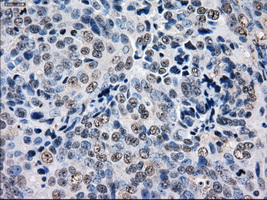 GBE1 Antibody - Immunohistochemical staining of paraffin-embedded Adenocarcinoma of ovary tissue using anti-GBE1 mouse monoclonal antibody. (Dilution 1:50).