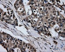 GBE1 Antibody - Immunohistochemical staining of paraffin-embedded Adenocarcinoma of breast tissue using anti-GBE1 mouse monoclonal antibody. (Dilution 1:50).