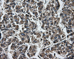 GBE1 Antibody - Immunohistochemical staining of paraffin-embedded Carcinoma of liver tissue using anti-GBE1 mouse monoclonal antibody. (Dilution 1:50).