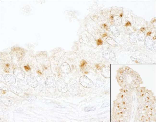 GBF1 Antibody - Detection of Human GBF1 by Immunohistochemistry. Sample: FFPE section of human prostate carcinoma. Antibody: Affinity purified rabbit anti-GBF1 used at a dilution of 1:250.
